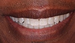 Closeup of perfectly aligned teeth after Invisalign