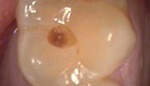 Dark area of decay on tooth