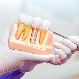 a dentist showing a model of dental implants