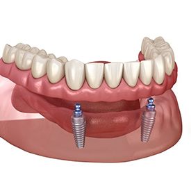 Illustration of removable implant denture for lower arch