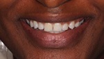 Closeup of woman's unevenly spaced teeth