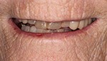 Closeup of damaged and discolored teeth