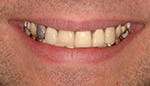 Closeup of yellowed damaged teeth
