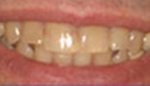 Closeup of decayed and discolored teeth
