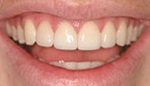 Closeup of beautiful smile after veneer placement