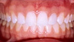 Brilliant white teeth after whitening
